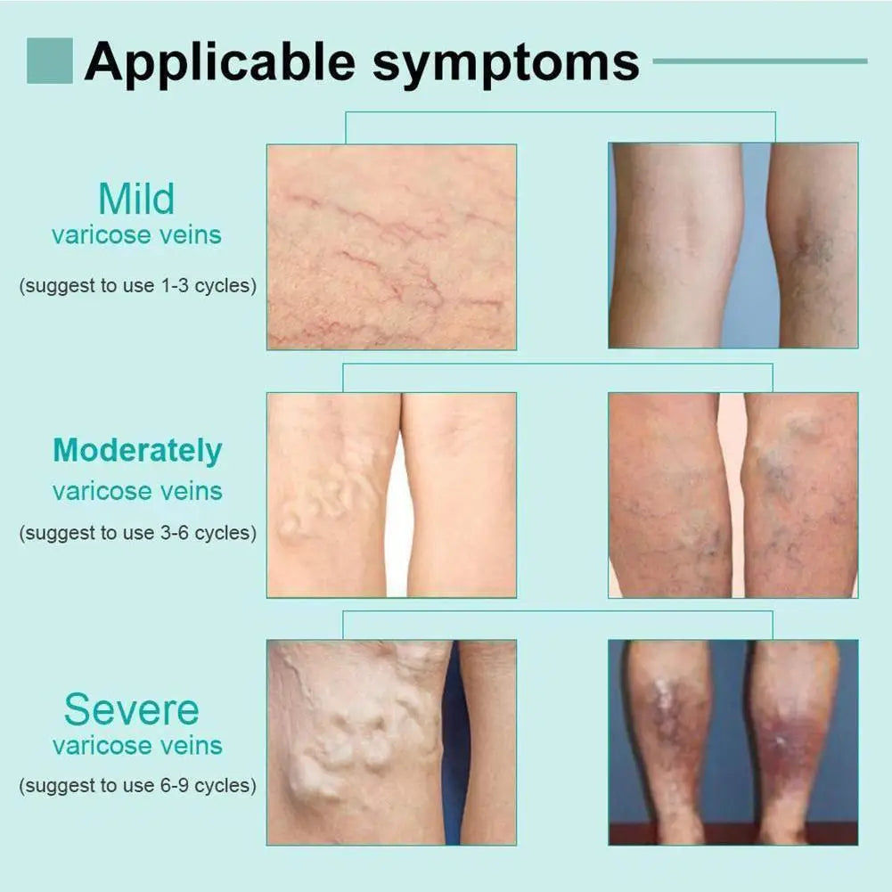 Heath Blue Light Therapy Varicose Veins Treatment Laser Pen Soft Scar Wrinkle Removal Treatment Acne Laser Pen Massage Relax 